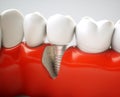 Dental implant - 3d rendering Royalty Free Stock Photo