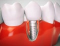 Dental implant - 3d rendering Royalty Free Stock Photo