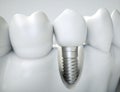 Dental implant - 3d rendering