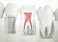 Dental implant - 3d rendering Royalty Free Stock Photo