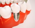 Dental implant - 3d rendering Royalty Free Stock Photo