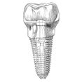 Dental implant dentistry sketch hand drawn sketch, engraving style Royalty Free Stock Photo
