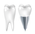 Dental implant dentistry Royalty Free Stock Photo