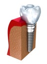 Dental implant - education model Royalty Free Stock Photo