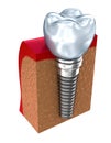 Dental implant - education model Royalty Free Stock Photo