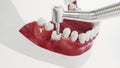 Dental implant on the example of a jaw model - 3D rendering Royalty Free Stock Photo