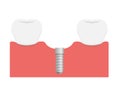 Dental implant flat vector illustration /  implant in jaw bone Royalty Free Stock Photo