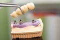 Dental implant head and bridge Royalty Free Stock Photo