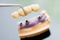 Dental implant head and bridge Royalty Free Stock Photo