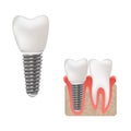 Dental implant and healthy teeth scientific modern design, realistic vector