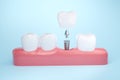 Dental implant with healthy tooth and gums