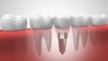 Dental implant in human denturra