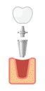 Dental Implant and Human Teeth Set. Vector Royalty Free Stock Photo