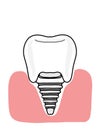 dental implant illustration cartoon icon and gingival white colors