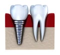 Dental implant - implanted in jaw bone