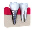 Dental implant - implanted in jaw bone Royalty Free Stock Photo