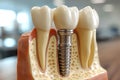 A dental implant implanted into the jaw bone Royalty Free Stock Photo