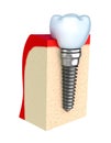 Dental implant in jaw bone Royalty Free Stock Photo