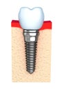 Dental implant in jaw bone