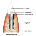 Dental implant medical  illustration on white background Royalty Free Stock Photo