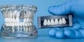 dental implant model alongside a gloved hand holding porcelain crowns Royalty Free Stock Photo