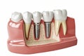 dental implant model with a translucent gum overlay, revealing the implant's positioning beneath the gumline. Royalty Free Stock Photo