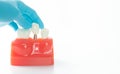 Dental implant model on white background