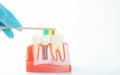 Dental implant model on white background