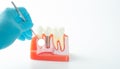 Dental implant model on white background