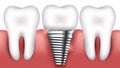 Dental implant and normal teeth Royalty Free Stock Photo