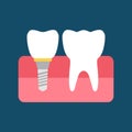 A dental implant and a normal tooth. Flat vector illustration isolated Royalty Free Stock Photo