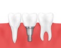 Dental implant and normal tooth vector illustration Royalty Free Stock Photo