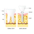 Dental implant, and Normal tooth Royalty Free Stock Photo