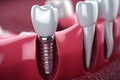 Dental implant oral. Generate Ai