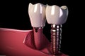 Dental implant oral. Generate Ai