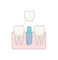 A dental implant placed between two healthy teeth, the abutment is covered with a crown. ivector illustration, in a flat Royalty Free Stock Photo