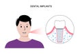 Dental implant procedure