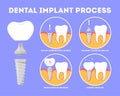 Dental implant process. Medical treatment and dentistry.