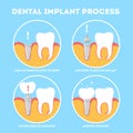 Dental implant process. Medical treatment and dentistry.