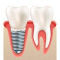 Dental implant set. EPS 10 Royalty Free Stock Photo