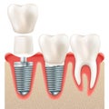 Dental implant set. EPS 10 Royalty Free Stock Photo