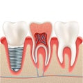 Dental implant set. EPS 10 Royalty Free Stock Photo