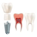 Dental implant set. EPS 10 Royalty Free Stock Photo