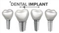 Dental Implant Set Vector. Implant Structure. Crown, Abutment, Screw. Care, Stomatology. Realistic Isolated Illustration Royalty Free Stock Photo