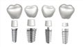 Dental Implant Set Vector. Tooth Set. Dental Health. Stomatology Dentistry. Whitening Design. Realistic Isolated