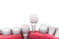 Dental implant structure Royalty Free Stock Photo