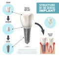 Dental Implant Structure Medical Infographic Poster Royalty Free Stock Photo