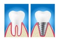 Dental implant structure medical / tooth and teeth concept vector