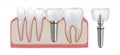 Dental implant. Teeth care surgery and crown fixture. Tooth replacement and prosthesis treatment. Implantation of artificial molar