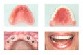 Dental implant of upper jaw